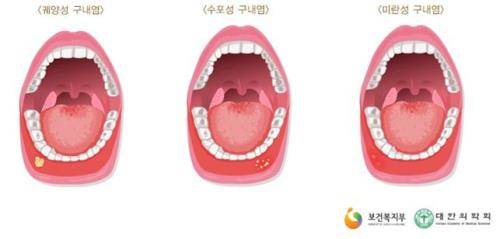 구내염의 종류. ⓒ 보건복지부
