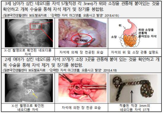 소형강력자석세트 안전사고 초래한 사례. ⓒ 한국소비자원