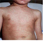 홍역에 의한 피부 발진은 홍반성 구진형태로 앞머리에서부터 생긴 후 얼굴, 목, 팔, 몸통, 대퇴부, 발까지 퍼진 다음 발진이 나타났던 순서대로 없어진다. ⓒ 대동병원