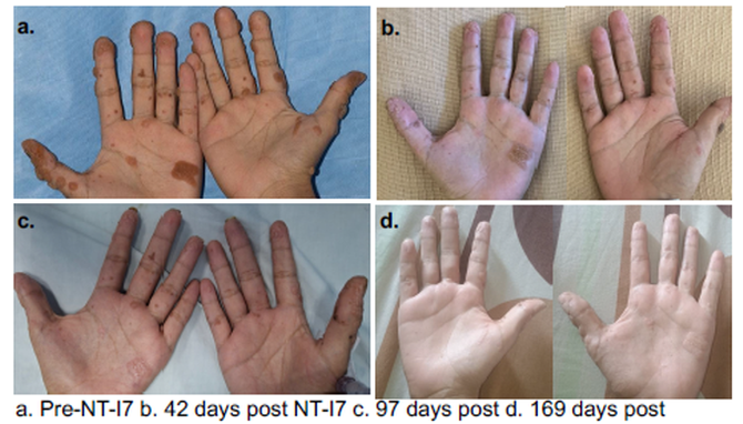 NT-I7 투여로 인한 피부 병변 개선 결과, 출처: ESID-EHA-SIOPE Focused Symposium 발표 포스터. ⓒ 네오이뮨텍
